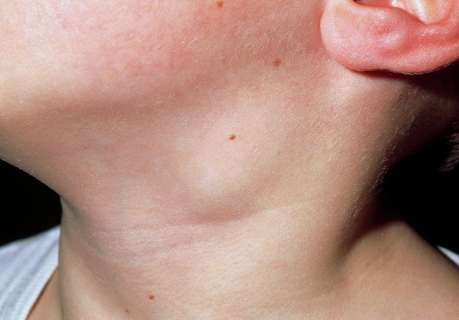 Siêu âm hạch vùng cổ Tổng quan Chỉ định