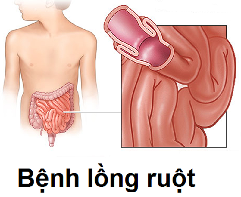 Tìm hiểu về Lồng ruột ở Trẻ em