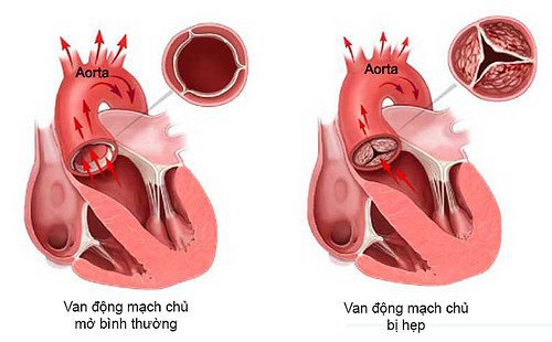Vai trò của siêu âm trong chẩn đoán hở van tim