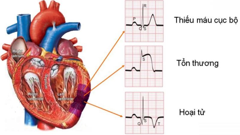 Vai trò của siêu âm trong chẩn đoán hở van tim