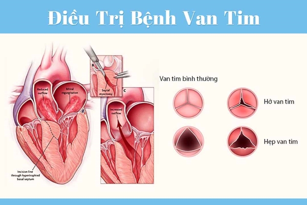 Vai trò của siêu âm trong chẩn đoán hở van tim
