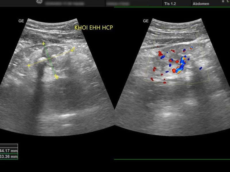 Siêu âm bụng tổng quát – Đo kích thước khối EHH HCP.