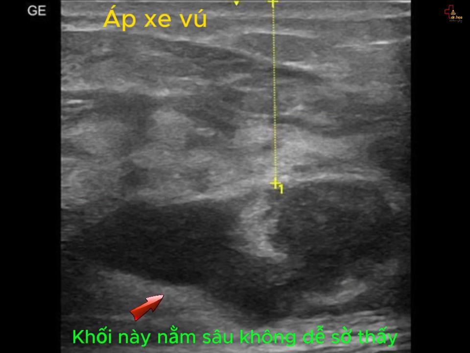 Áp xe vú – Khối echo hỗn hợp nằm cách da 3cm nên không dễ sờ chạm. Áp xe vú – Khối echo hỗn hợp nằm cách da 3cm nên không dễ sờ chạm.