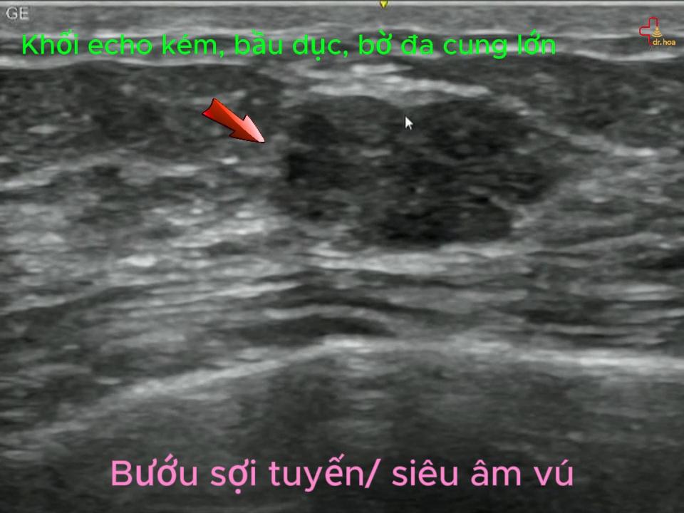 Bướu sợi tuyến vú – Khối echo kém, bầu dục, bờ đa cung lớn. Bướu sợi tuyến vú – Khối echo kém, bầu dục, bờ đa cung lớn.
